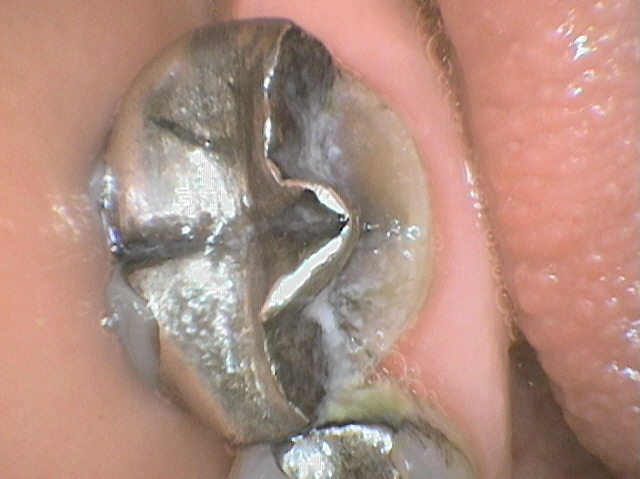 Broken Tooth Grande Prairie, AB